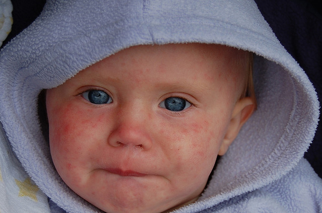 The measles, in case you've never seen it (you might soon); Photo: Flickr user Dave Haygarth, CC BY 2.0